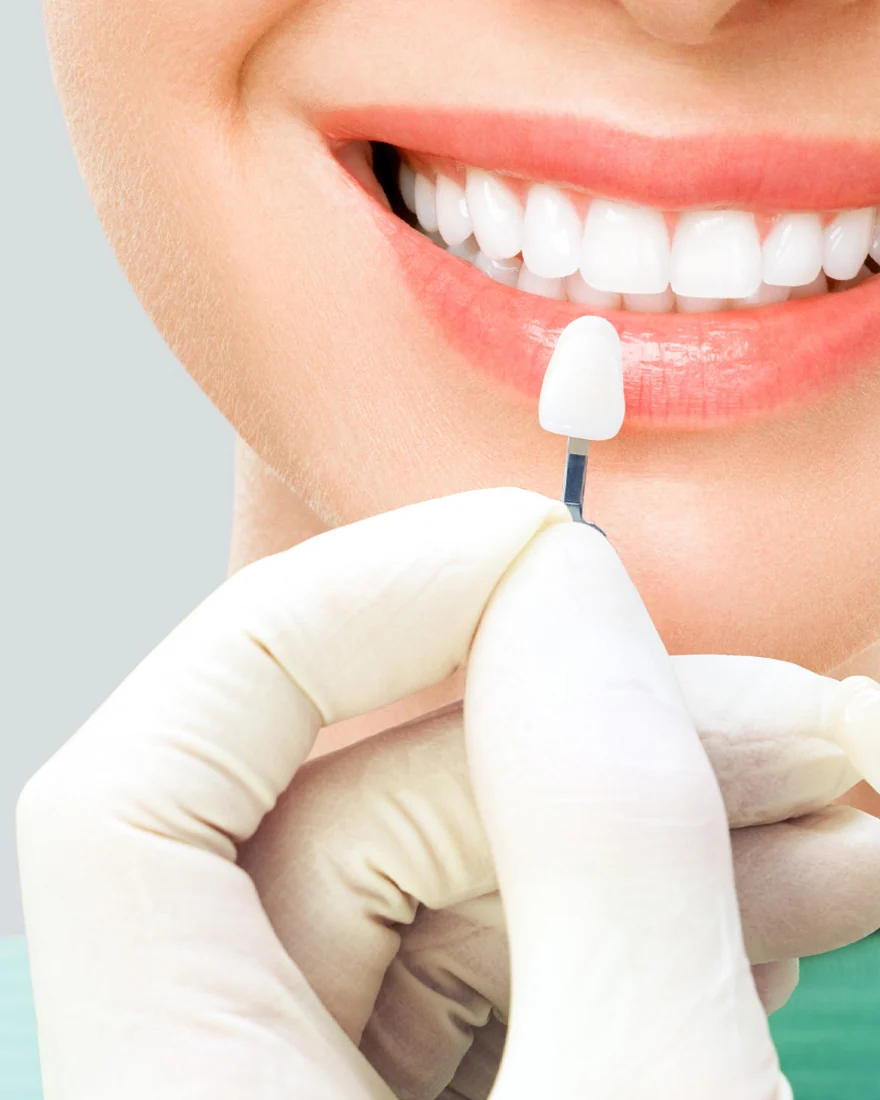 Selección de color para carillas dentales
