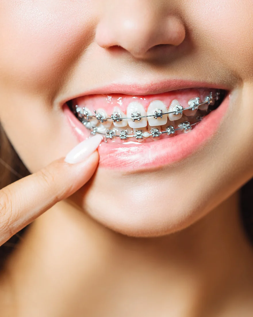 Sonrisa con brackets de ortodoncia