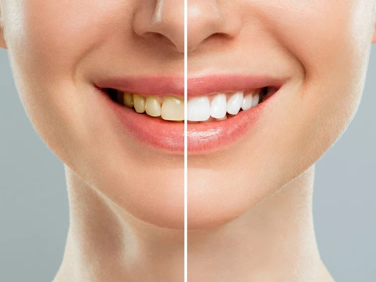 Blanqueamiento dental