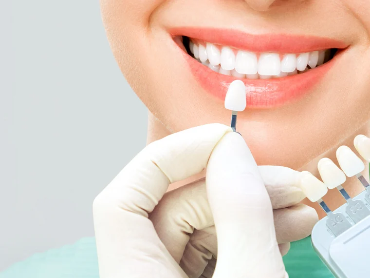 Carillas dentales en zirconia y resina