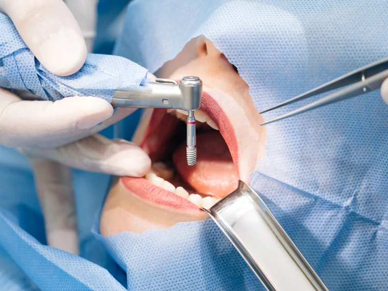 Extracciones dentales