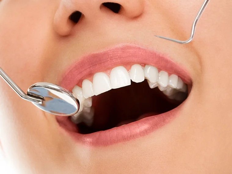 Limpieza dental profesional
