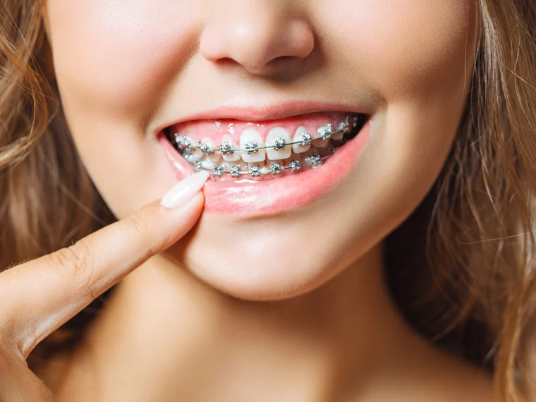 Ortodoncia con brackets